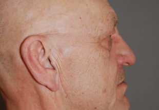 Patient till Stockholm Plastikkirurgi som utfört halslyft och övre ögonlocksplastik hos plastikkirurg Marie Forseni