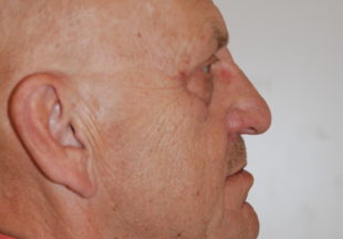 Patient till Stockholm Plastikkirurgi som utfört halslyft och övre ögonlocksplastik hos plastikkirurg Marie Forseni