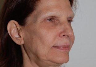 Patient till Stockholm Plastikkirurgi som utfört ansiktslyft hos plastikkirurg Marie Forseni