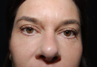 Patient till Stockholm Plastikkirurgi som utfört övre ögonlocksplastik hos plastikkirurg Marie Forseni