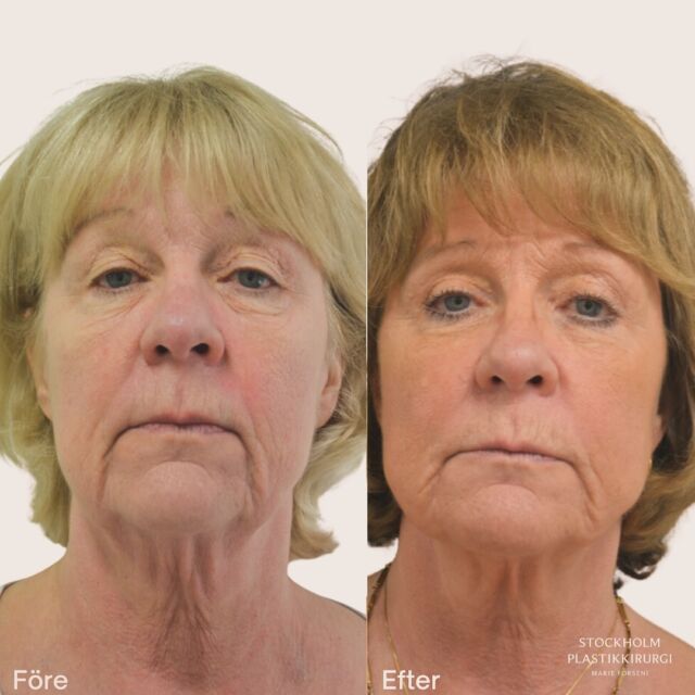 🌟WOW!🌟

Kolla in vår fantastiska kund som precis har fått ett facelift hos oss!

Resultatet är otroligt naturligt och lyfter verkligen fram hennes unika skönhet.

Vi är så glada över att få vara en del av hennes resa mot en fräschare och mer strålande version av sig själv.

Vill du också uppnå ett naturligt och fantastiskt resultat? Boka din konsultation idag!📞